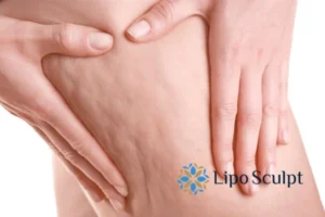 CoolSculpting for Legs: The Innovative Approach to Redefining Your Legs 5 Start your journey today book your coolsculpting treatment Swindon online today!