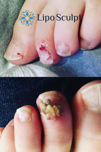 Wart removal customer results from Lipo Sculpt Swindon